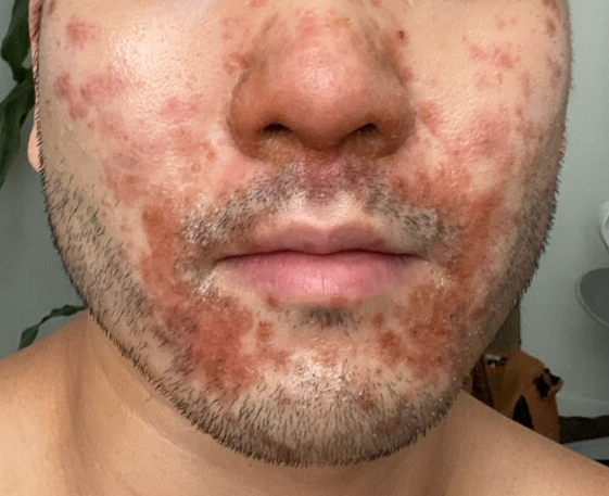 Rash over face in Monkey pox