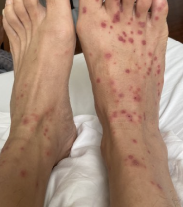 Rash over feet and soles in Monkey pox