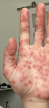 Rash over hand in Monkey pox