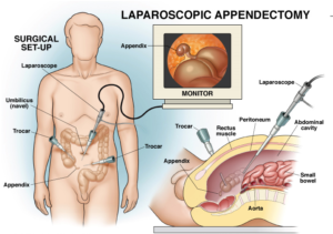 treatment of appendicitis