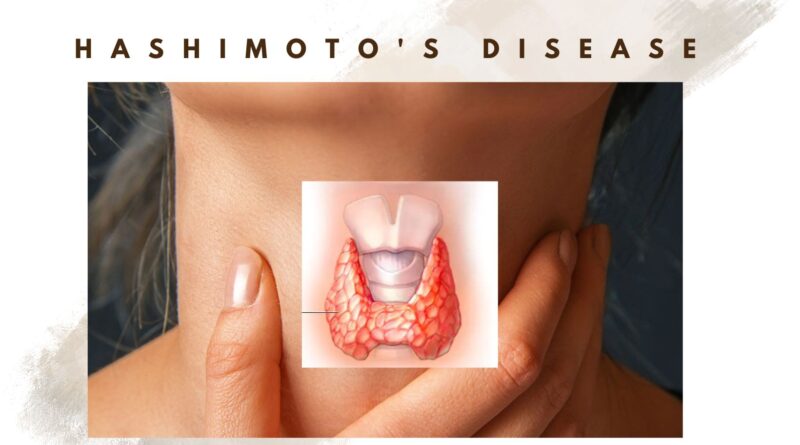 hashimoto-s-disease-a-thyroid-disease-how-to-deal-with-this