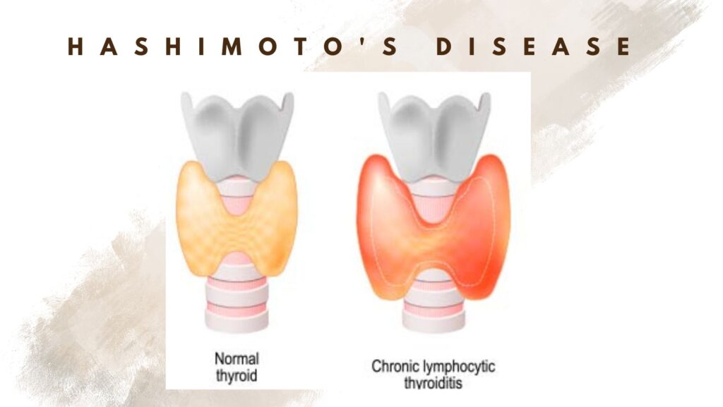 hashimoto-s-disease-a-thyroid-disease-how-to-deal-with-this