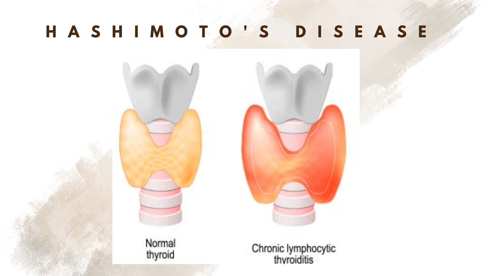 Hashimoto's Disease - a thyroid disease, how to deal with this ...