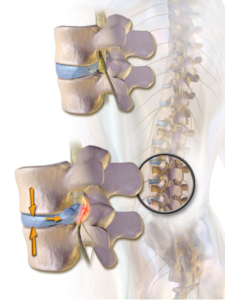 What herniated disc