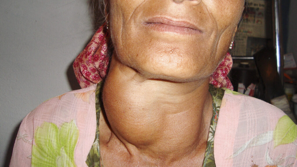 Thyroid Problems - what you need to know ?