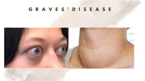 graves-disease