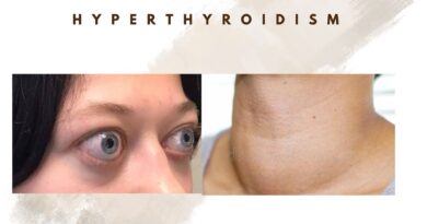 hyperthyroidism
