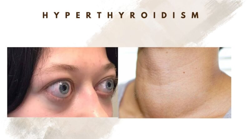 5-signs-and-symptoms-of-hyperthyroidism-how-to-manage-jayyush-hospital