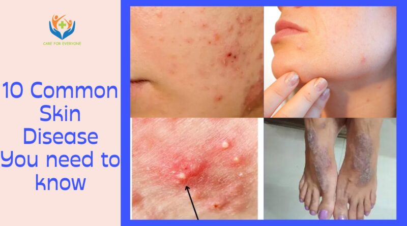 10 Common Skin Disease You need to know