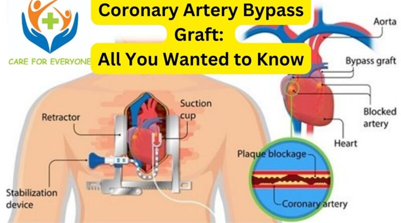 Coronary Artery Bypass Graft: All You Wanted to Know